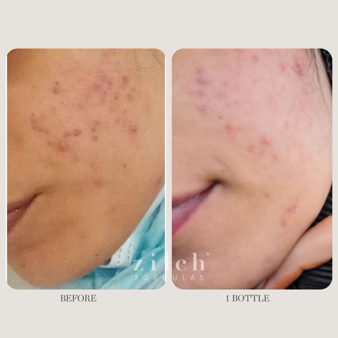 Zilch Acne Formula Before and After photo review