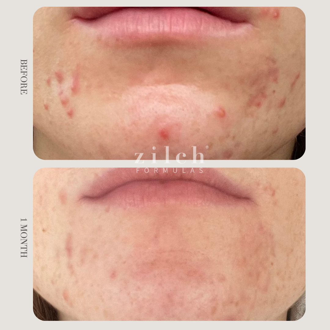 Zilch Acne Formula Before and After photo Review