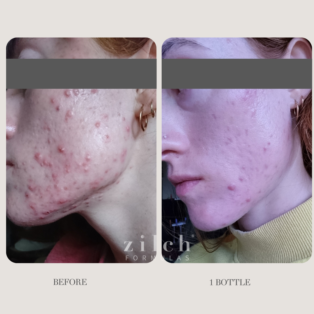 Zilch Acne Formula Before and After photo Review