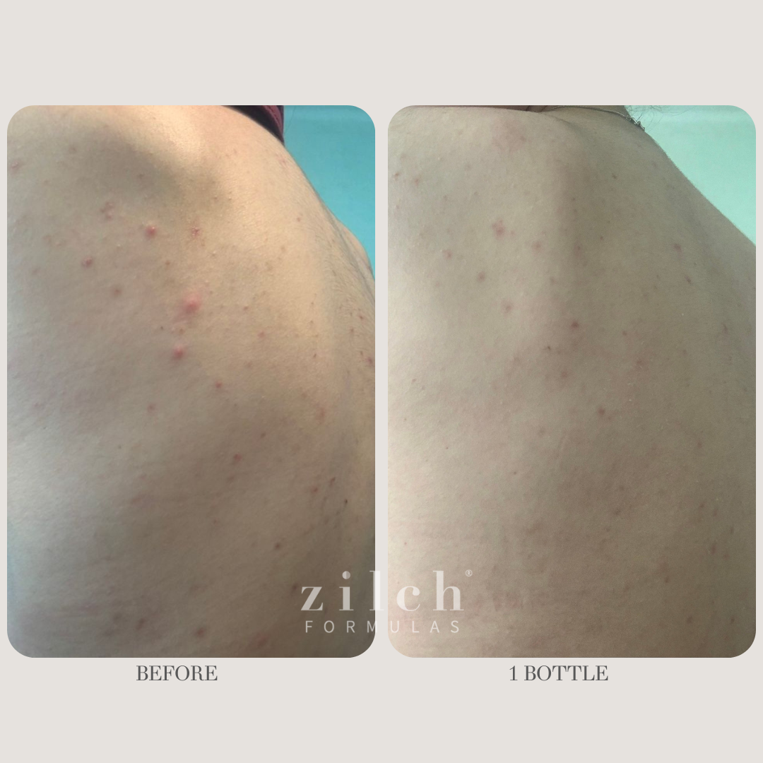 Zilch Acne Formula Before and After photo review