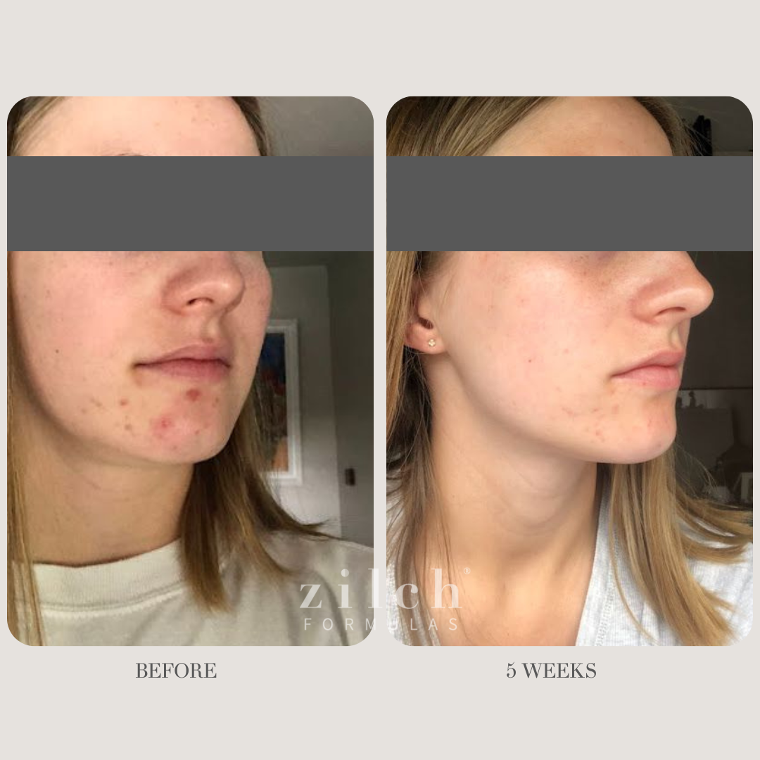 Zilch Acne Formula Before and After photo Review