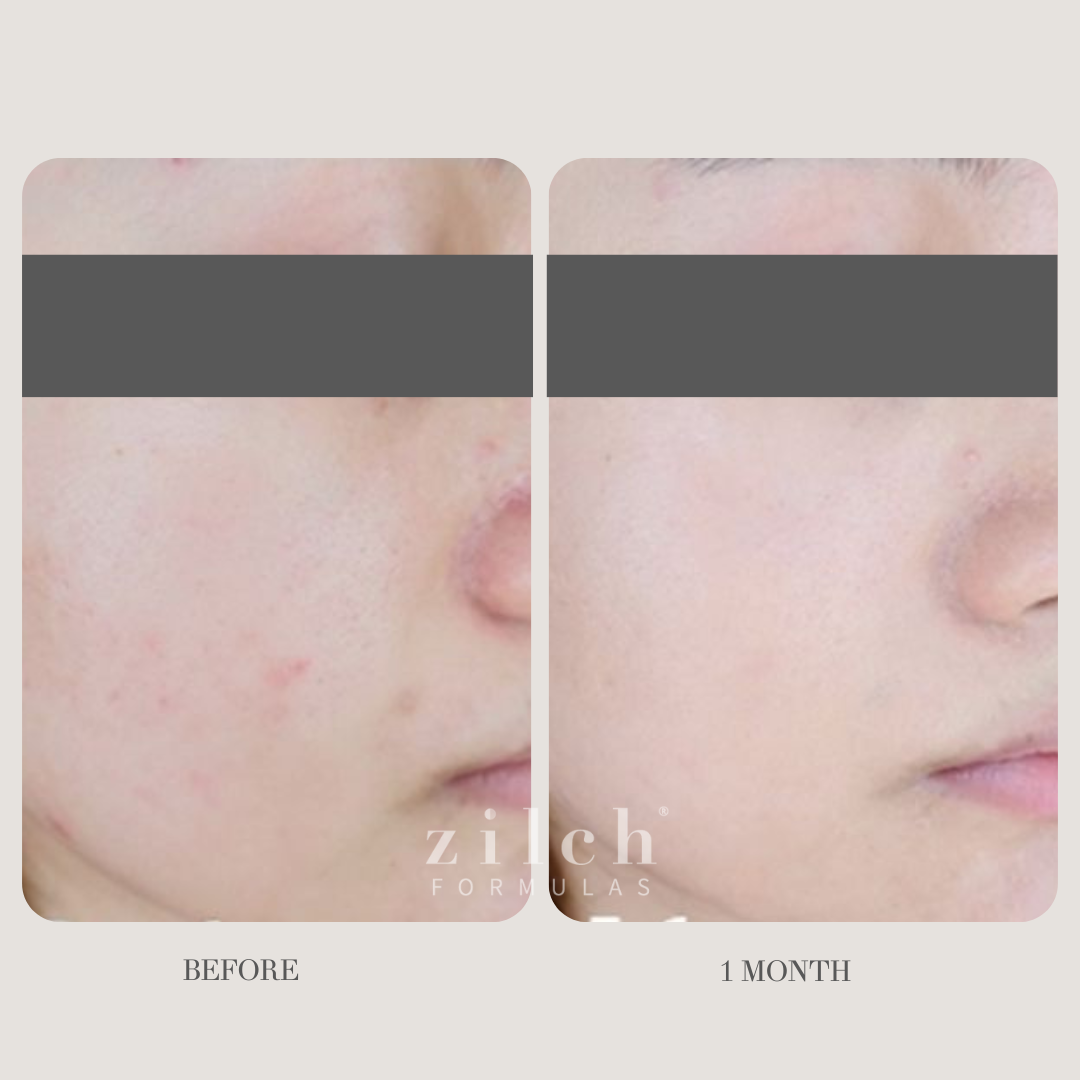 Zilch Acne Formula Before and After photo Review