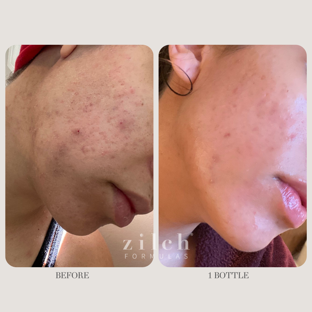 Zilch Acne Formula Before and After photo Review 