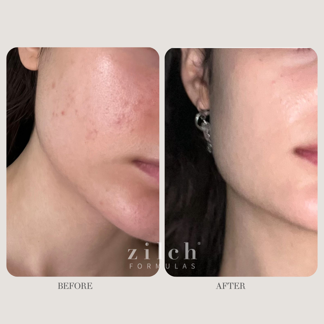 Zilch Acne Formula Before and After photo Review