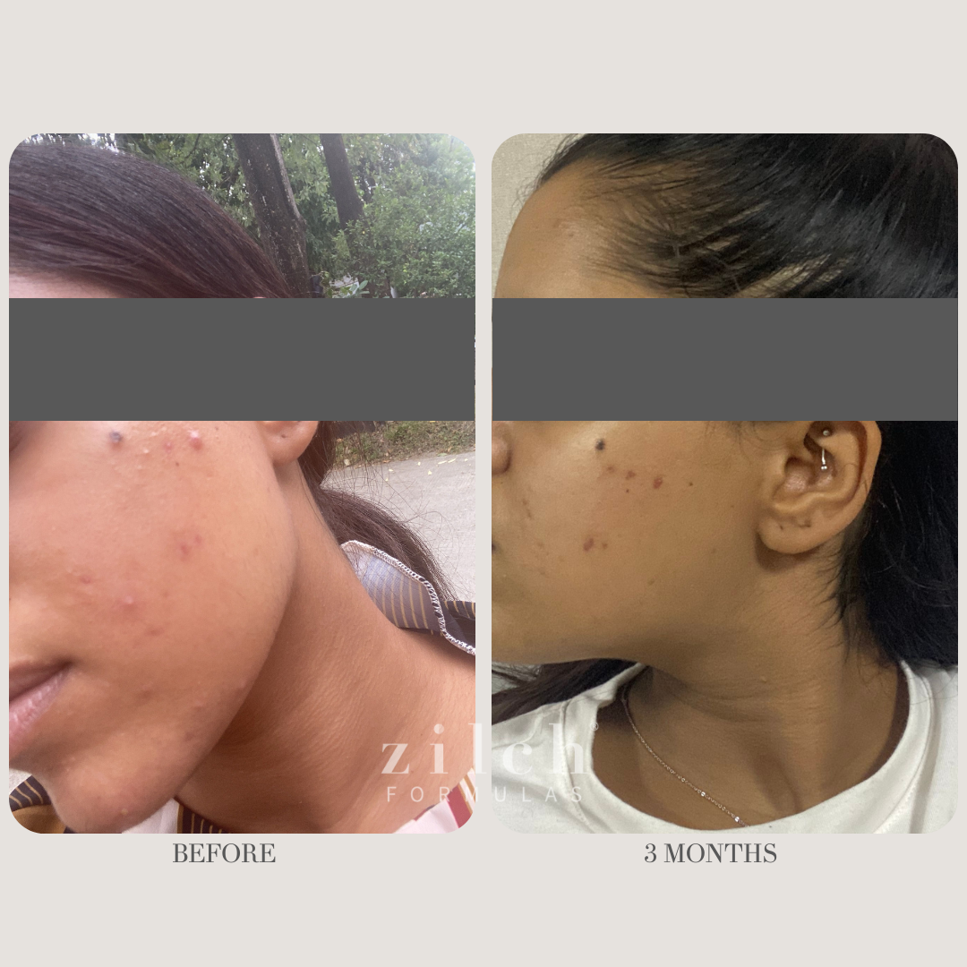 Zilch Acne Formula Before and After photo Review