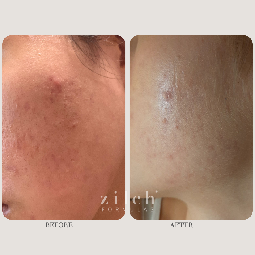 Zilch Acne Formula Before and After photo Review