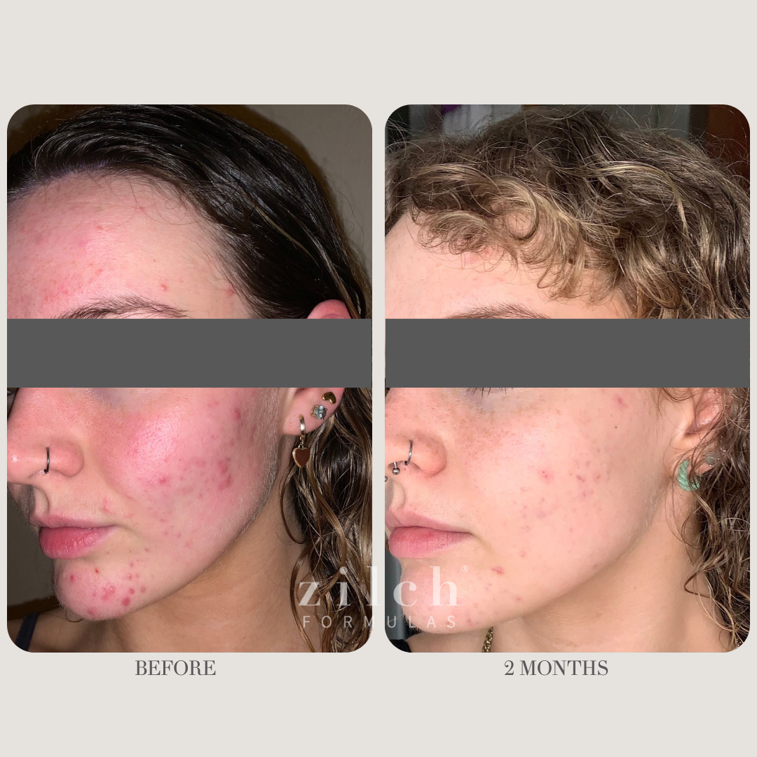 Zilch Acne Formula Before and After photo Review