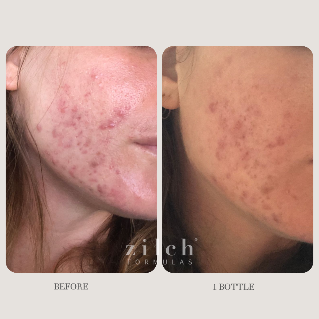 Zilch Acne Formula Before and After photo Review