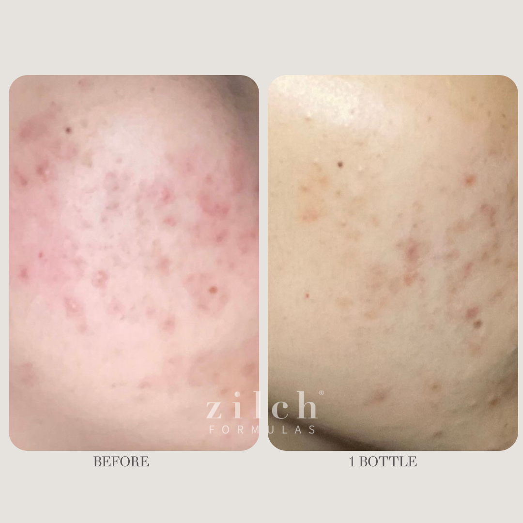 Zilch Acne Formula Before and After photo review 