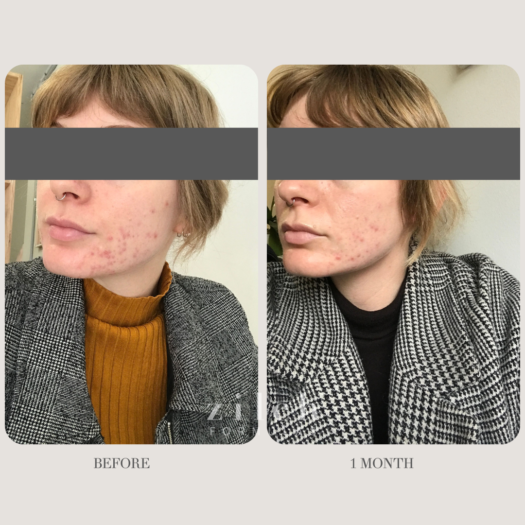 Zilch Acne Formula Before and After photo Review