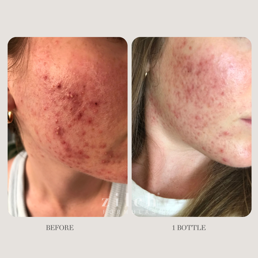 Zilch Acne Formula Before and After photo Review