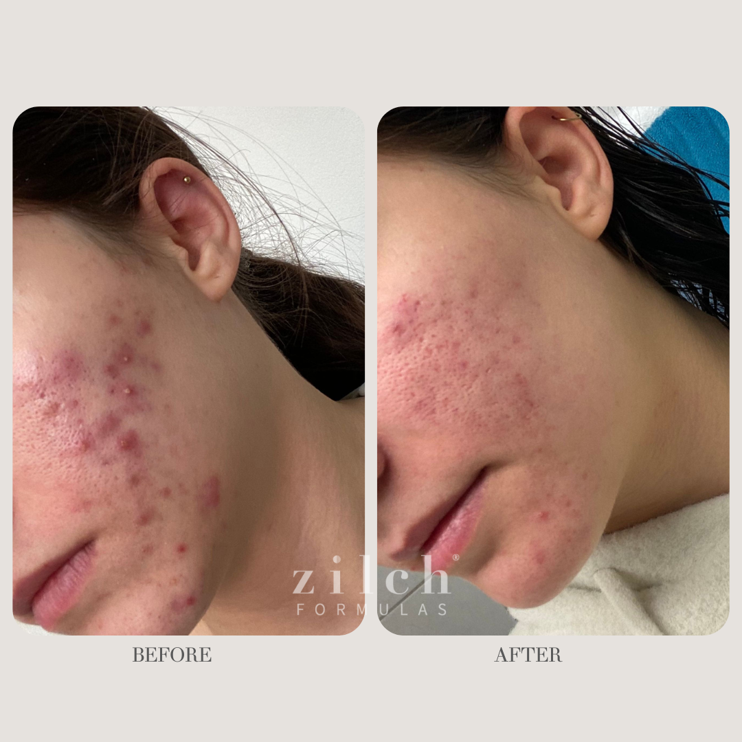 Zilch Acne Formula Before and After photo Review