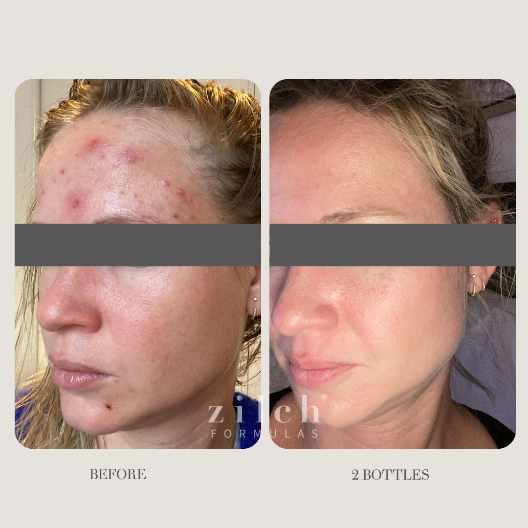 Zilch Acne Formula Before and After photo review 