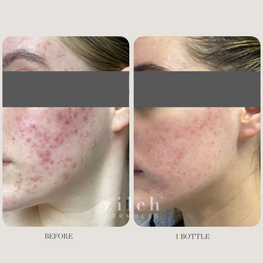 Zilch Acne Formula Before and After photo Review