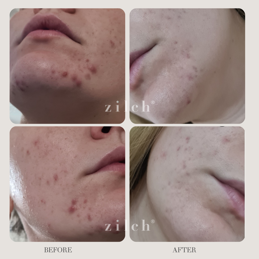 Zilch Acne Formula Before and After photo Review