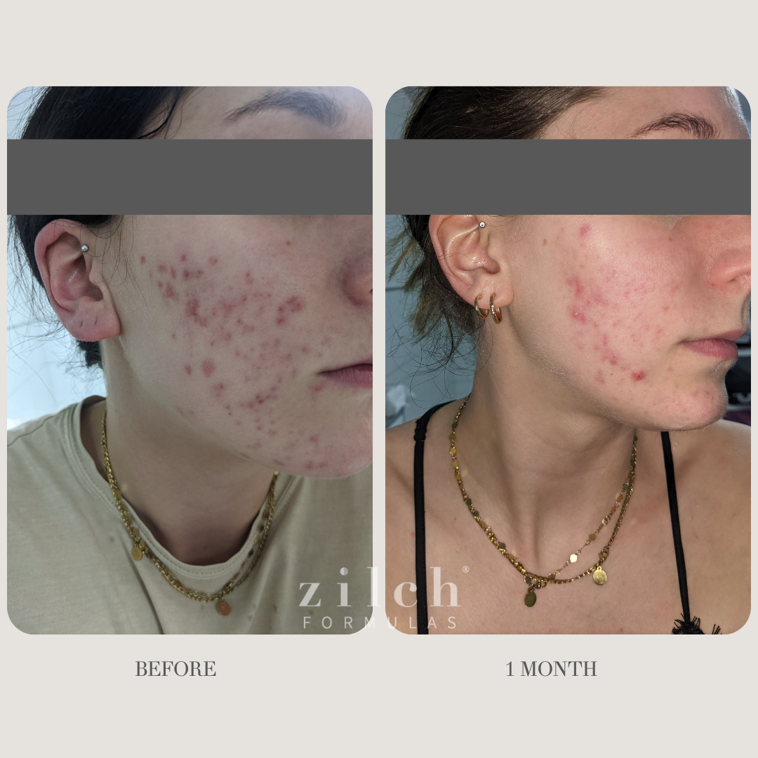 Zilch Acne Formula Before and After photo review