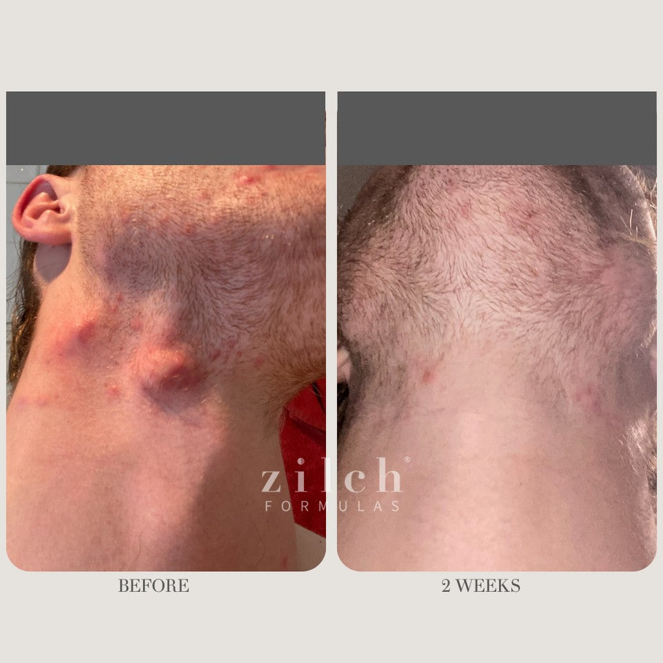 Zilch Acne Formula Before and After photo review