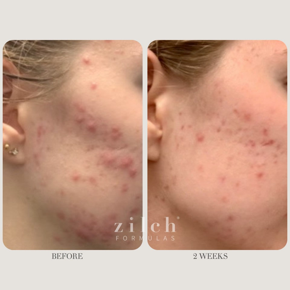 Zilch Acne Formula Before and After photo review