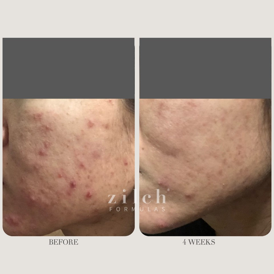 Zilch Acne Formula Before and After photo review